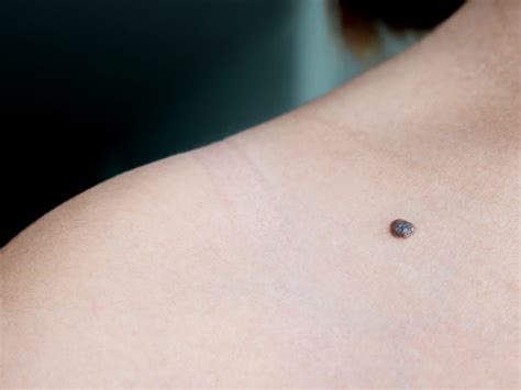Weird Signs Of Skin Cancer That Are Super Hard To Spot