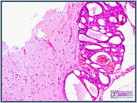 Salivary Duct Carcinoma With Brain Metastasis Surgical Pathology