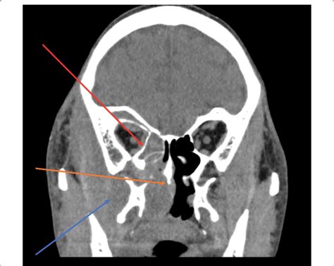 Ct Coronal View Right Buccal Mass Extending Into The Right Orbit And