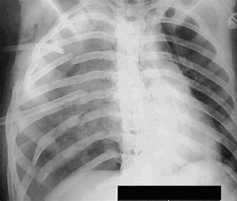 Chest X Ray Showing A Flail Chest Of The Right Haemithorax With Two