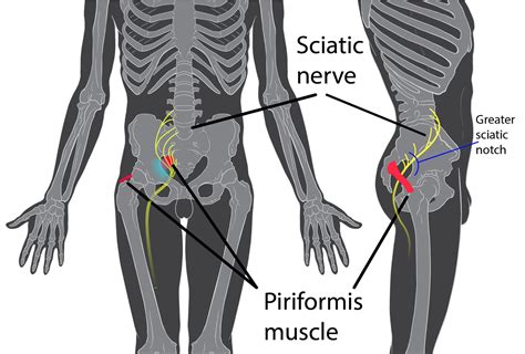 Piriformis Syndrome Wikipedia