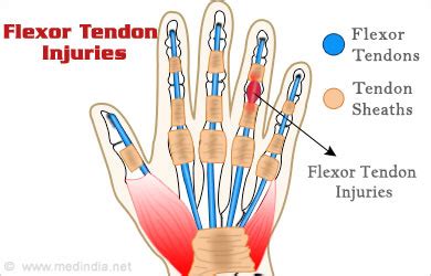 Nourishes flexor tendons located outside of synovial sheaths. Flexor Tendon Injuries - Causes, Symptoms, Diagnosis ...