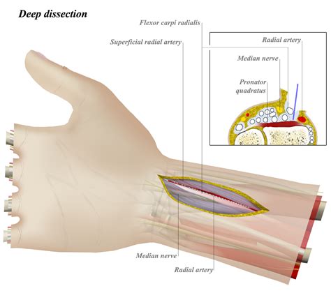 Fcr Approach To Distal Radius Approaches Orthobullets