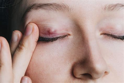 How To Get Rid Of A Stye—the Right Way The Healthy