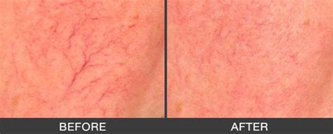 Clots form because a blood vessel is obstructed. Spider Veins - Athens Veins