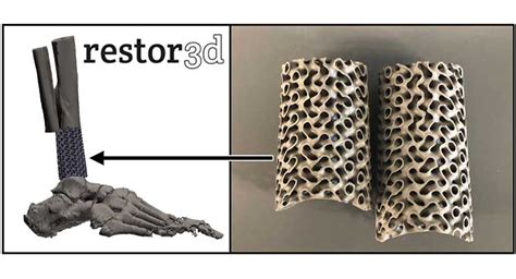 Does 3d Printing Add Value In Orthopedics Orthopedic Design Technology