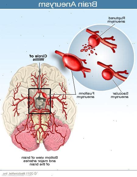 Un aneurisma cerebral no suele cursar con síntomas, pero es vital conocer toda la información para estar prevenidos y saber cómo actuar. Aneurisma cerebral - Payro