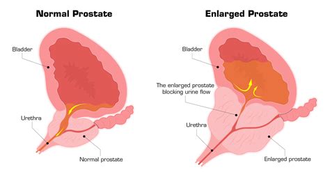 Benign Prostatic Hyperplasia Bph Surgery Ems Urology