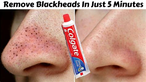How To Remove Blackheads Permanently From Face And Nose In Just 5 Minutes