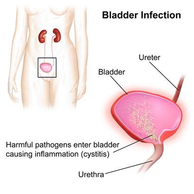 Urinary Tract Infection Women