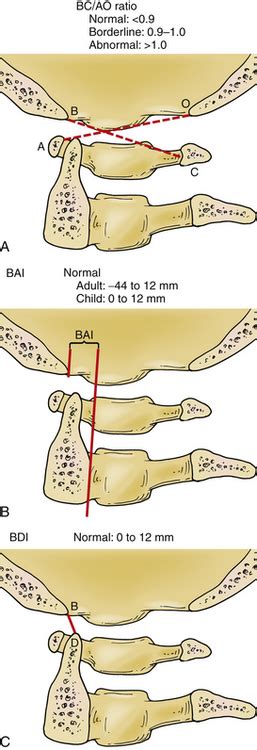 Craniovertebral Junction Deformities Clinical Gate