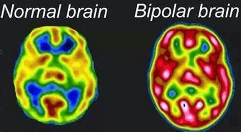 My mother's friend is a neuro icu nurse for 5 years and i was talking to her about this and my symptoms. Bipolar Patients Found to have Abnormal Brain Matter ...