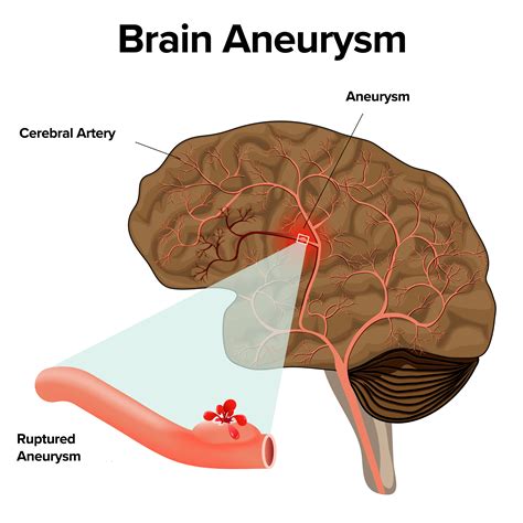 Even though the bleeding from a rupture typically lasts only for a few seconds, it can damage brain cells and increase pressure in the brain. Brain Aneurysm - Symptoms/Treatment | Atlantic Brain & Spine