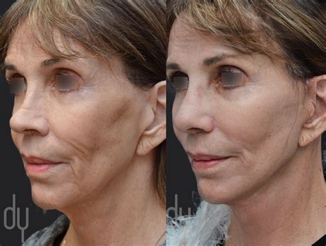 Before And After Deep Plane Facelift To Lift And Tighten The Jawline