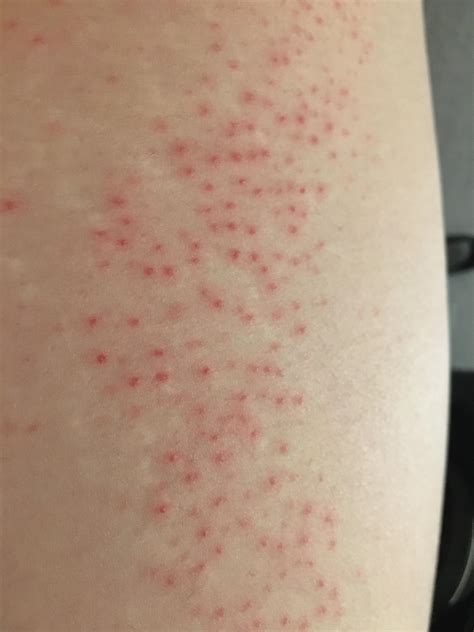 Rash On Thigh Is This Chickenpox Its Not Itchy But Its Spreading Rallergies