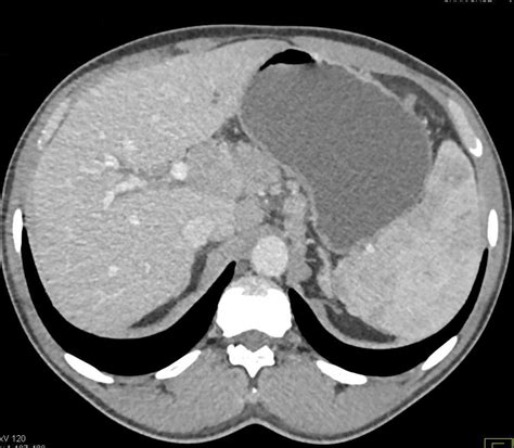 Lymphoma Infiltrates The Head Of The Pancreas And Adrenal Glands And