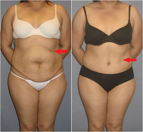 This Is A 36 Year Old 52 160 Lb Woman Who Sought Improvment Of Her Abdominal Shape She