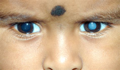 Phfi Cehj Common Eye Diseases In School Going Children