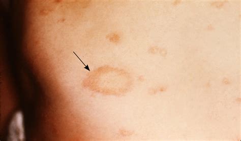 Common Skin Rashes In Children SỔ Tay LÂm SÀng