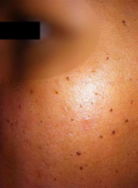 Age Warts Removal Marsden Skin Cancer Clinic