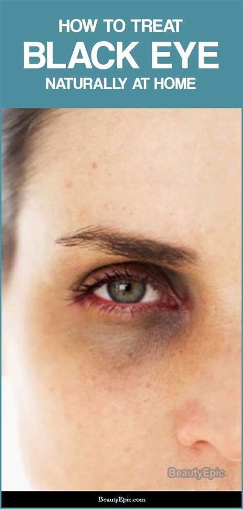 Get Rid Of That Black Eye With These 13 Effective Remedies Black Eye