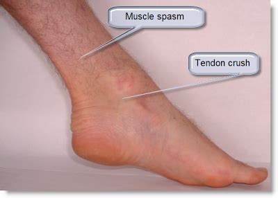 Lateral malleolus fractures cause pain, swelling, and bruising around the ankle. Photo Scanner: Ankle Pain