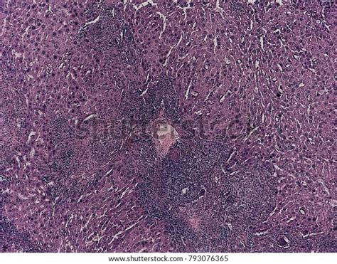 Human Pathology Foreign Body Granulome Hemosiderin Stock Photo