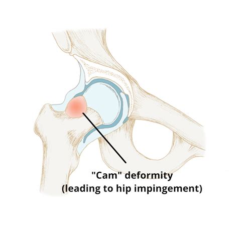 Hip Impingement Syndrome Circle Integrated Care