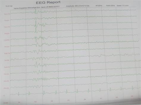 An Inter Ictal Eeg Sample Of A 5 Year Old Male With Panayiotopoulos