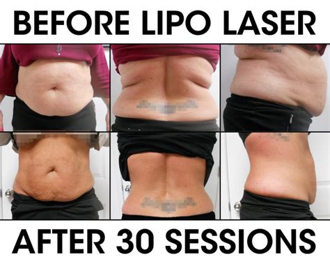 Lipo Laser Weight Loss Liberation Chiropractic Wellness