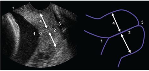Imaging Of The Uterine Cervix Radiology Key