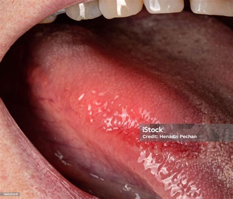 Entzündliche Erkrankung In Der Zunge Roter Fleck Glossitis Hygiene Der