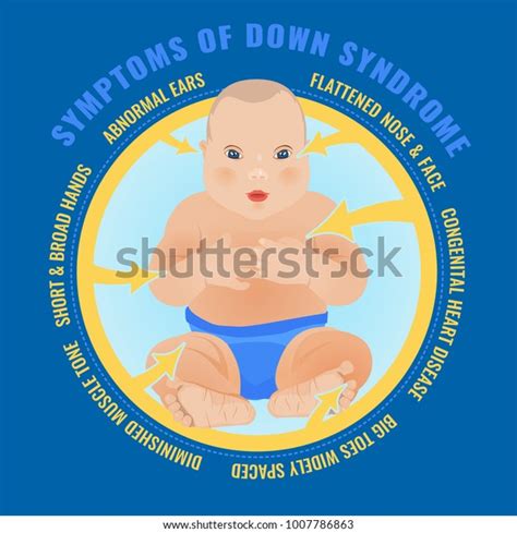 Symptoms Down Syndrome Poster Abnormal Ears Stock Vector Royalty Free