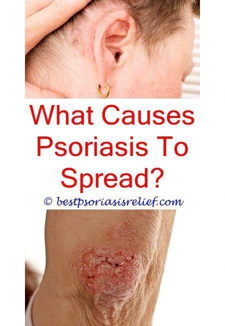 Dandruff And Itchy Scalp Conditions Explained Simply Psoriasis