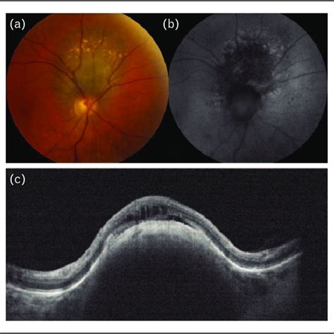 Pdf Choroidal Nevus A Review Of Prevalence Features Genetics