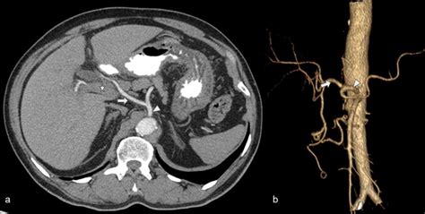 Ab Normal Hepatic Artery Anatomy And Its Relationship To Portal Vein