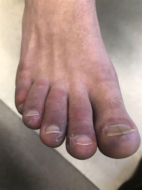A 12 Year Old Male Has Persistent Purple Toes And New Red Lesions On