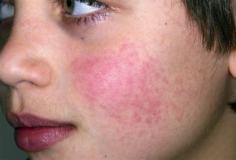Pictures Of Viral Skin Diseases And Problems Fifth Disease Erythema