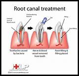 Root Canal Treatment Procedure Pictures Pictures