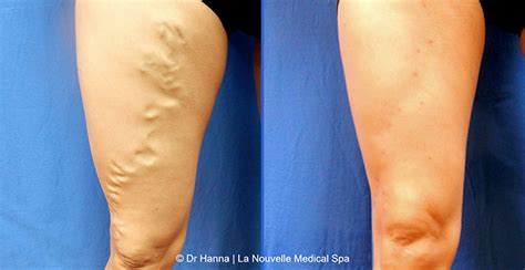Before And After Photos Of Varicose And Spider Vein Removal By Dr