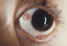 Bump On Eyeball Causes Symptoms Pictures Under Eyelid Get Rid