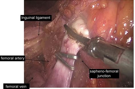 Videoscopic Inguinal Iliac Obturator Lymph Node Dissection New