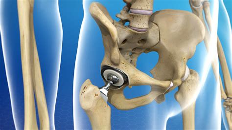 Physical Therapy After A Hip Replacement Theramax Rehabilitation