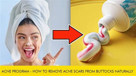 Acne program || how to remove acne scars from buttocks naturally