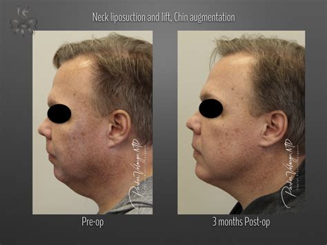 Chin Augmentation New Orleans New Orleans Center For Aesthetic And