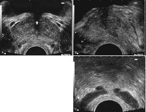 Ultrasonography And Biopsy Of The Prostate Abdominal Key