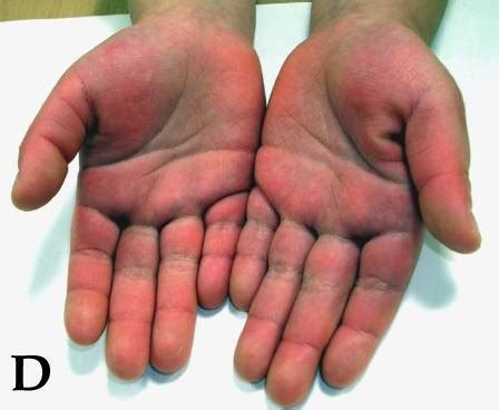 Palmar erythema causes red palms, which may feel slightly warm. Palmar erythema - Oxford Medical Education