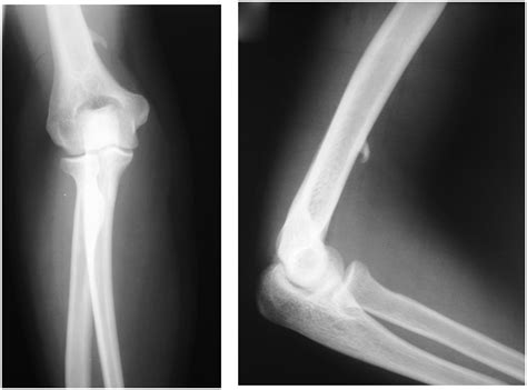 Normal Supracondylar Process Radrounds Radiology Network