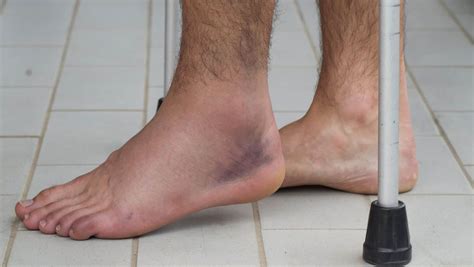 Sprained Ankle Vs Broken Ankle Explained By A Foot Expert