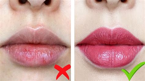 HOW TO Get Rid Of Dry Chapped Lips INSTANTLY YouTube